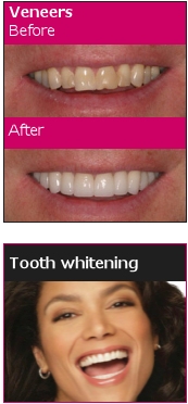 Tooth Whotening by One Complete Dental