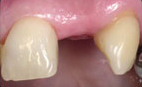 Tooth Implants - Hartforde Dental Centre