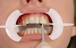 Tooth Whitening - Hartforde Dental Centre